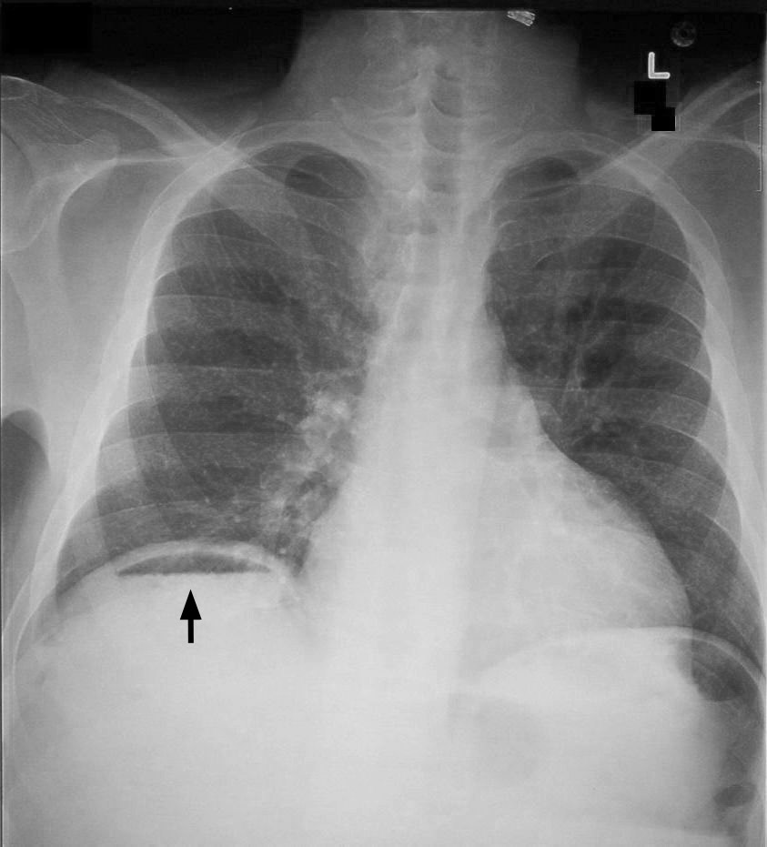 pneumoperitoneum on CXR
